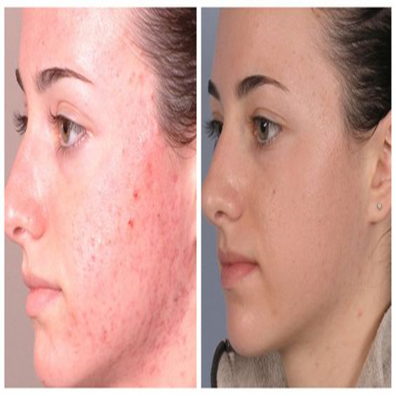Hot koop Microdermabrasie Diamond Peeling Schoonheid Machine Factory Direct Selling