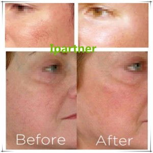 Ipartner LS980 Diodelaser verlicht het roodheidssysteem