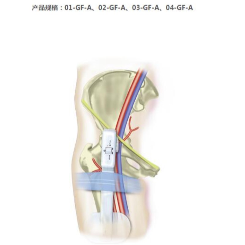 Goldfinger Electronic Femoral Hemostasis Compressie Device
