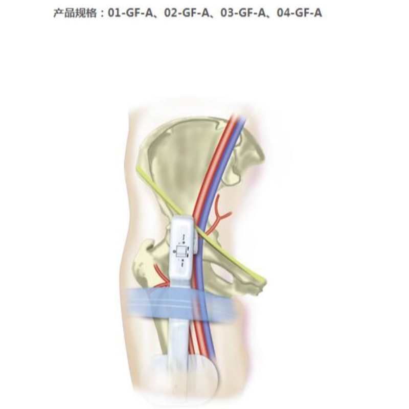 Goldfinger Electronic Femoral Hemostasis Compressie Device