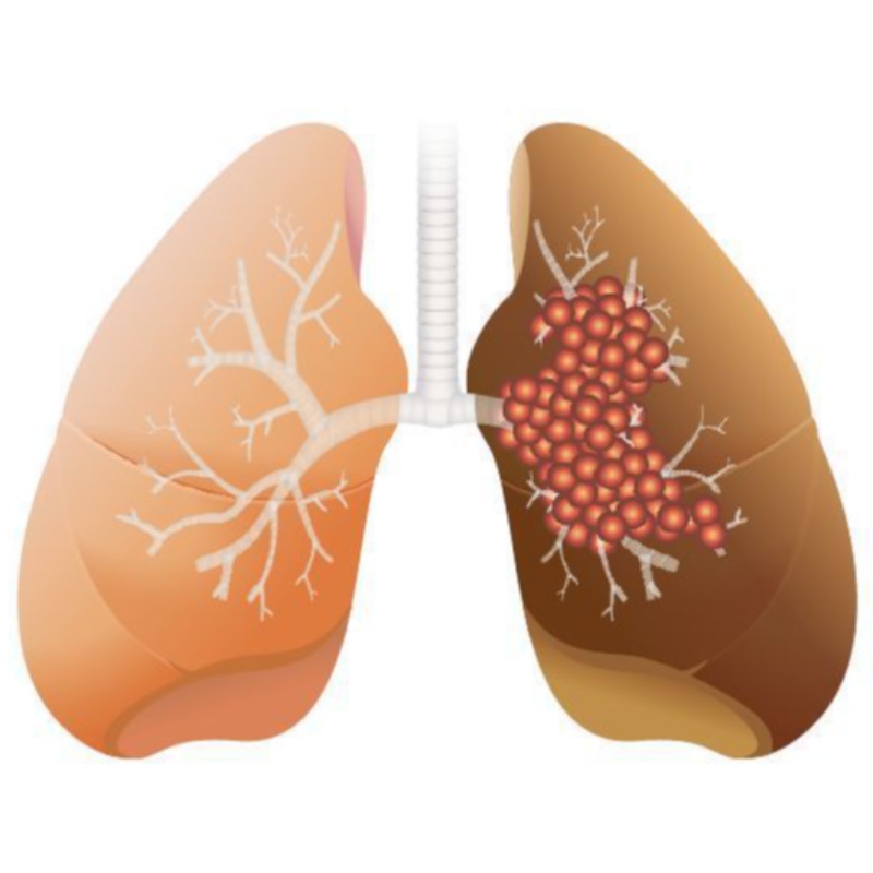 Hoge dosis NMN remt de groei van longadenocarcinoom