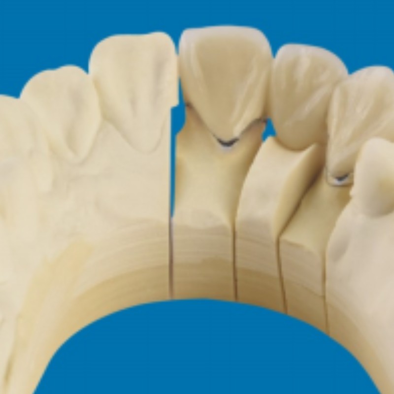 Metaal-porseleinen tanden